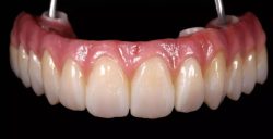 Model of full arch replacement implants