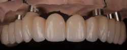 Model of full arch replacement implants