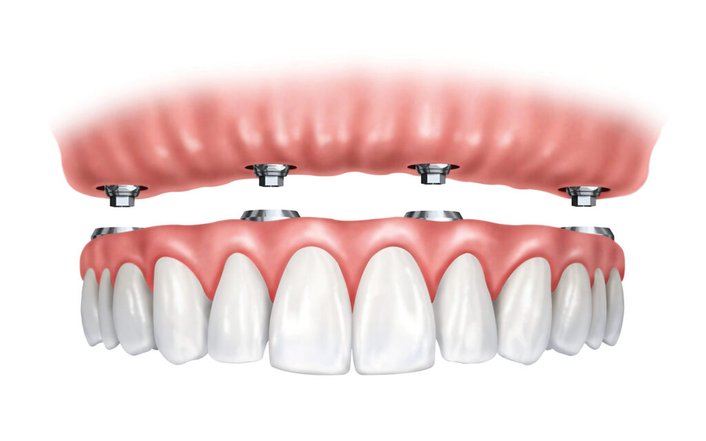 All on 4 with dental implants