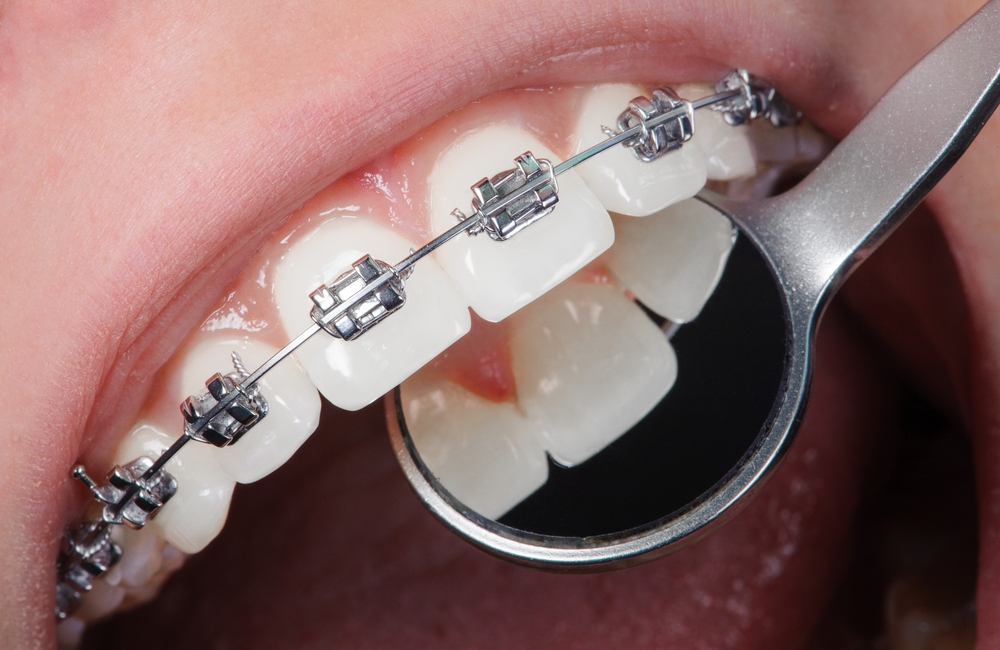 Dental braces