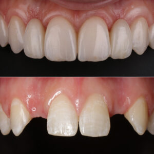 Dental Implant Metal