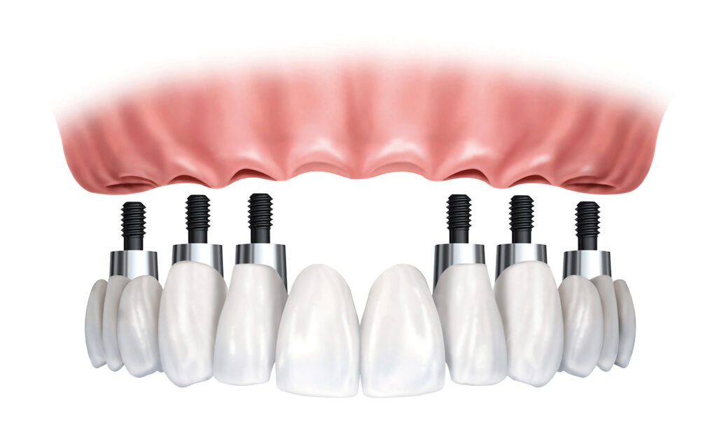 Full Arch Rehabilitation, all teeth replacement with six dental implants