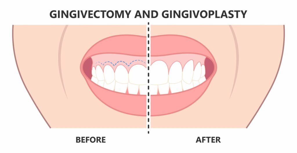 before and after graphic of Gingivectomy and Gingivoplasty