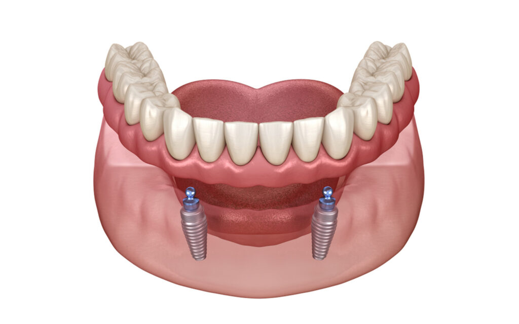 Overdenture with dental implant clips