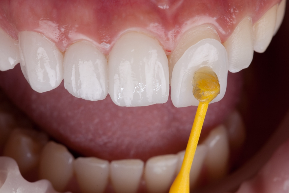 Porcelain Veneers being cemeted into a mouth