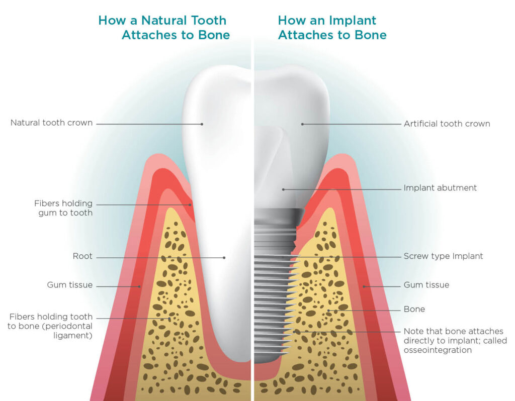 Natural Tooth Vs Dental Implant comparison
