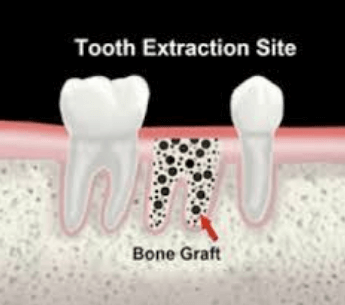 Tooth extraction