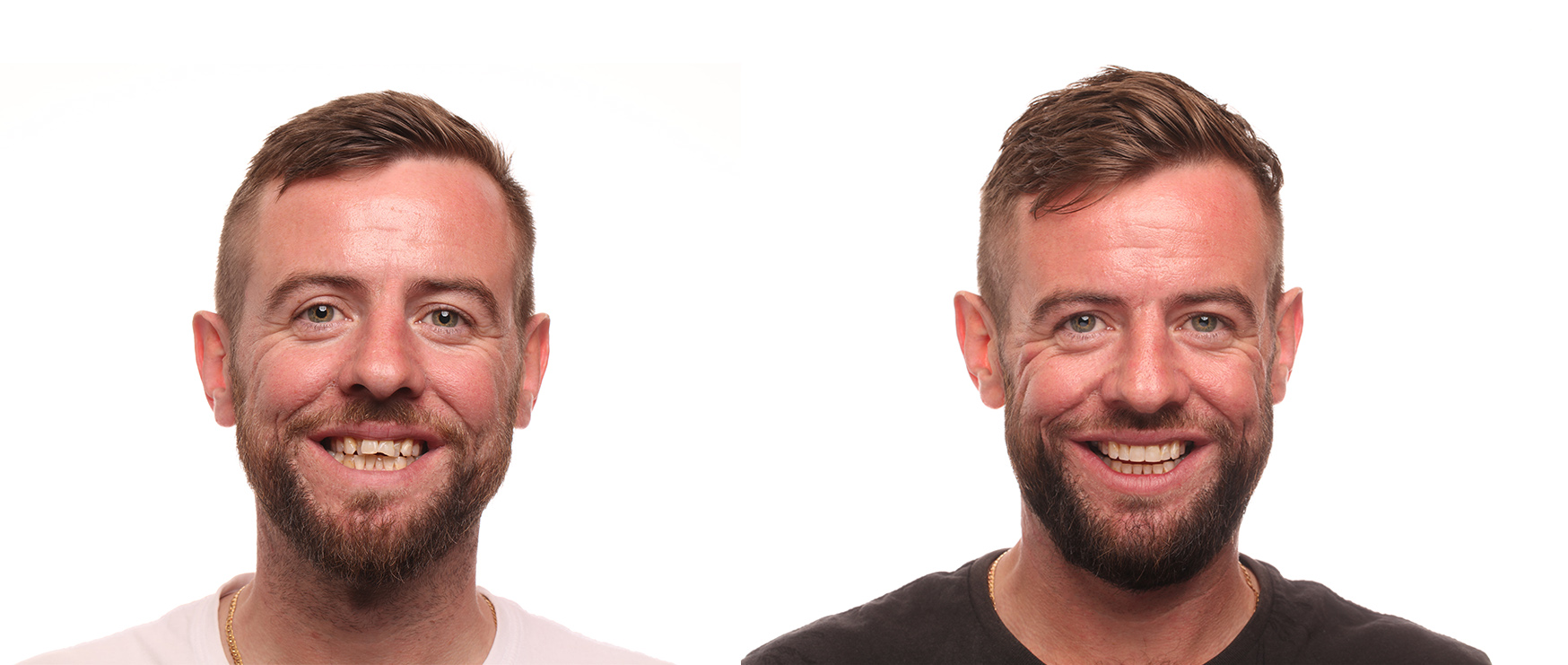 Man showing the Benefits of Invisalign