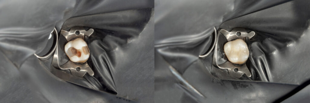 dental filling before and after
