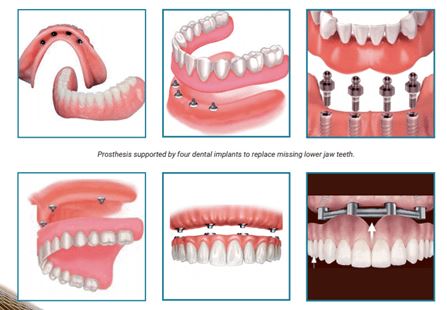 different dental supports for false teeth