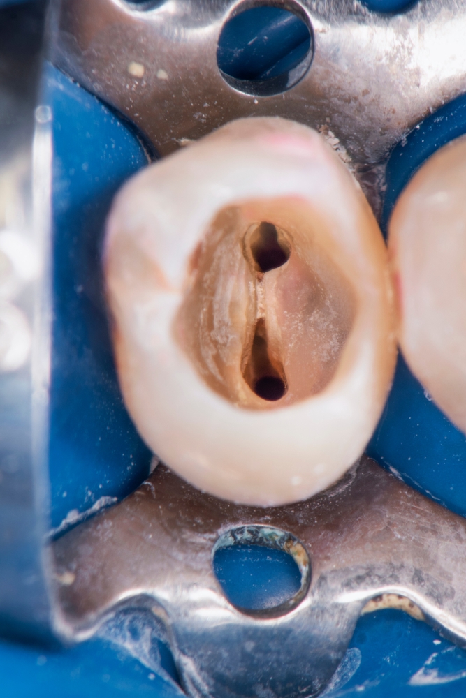 root canal procedure 