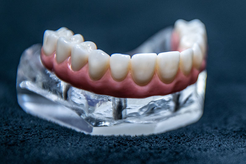 All-on-4 Dental Implants